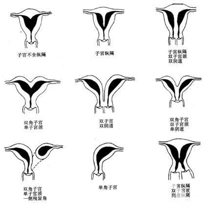 子宮畸形患者可以做試管嬰兒?jiǎn)幔? /></a>
					<div   id=