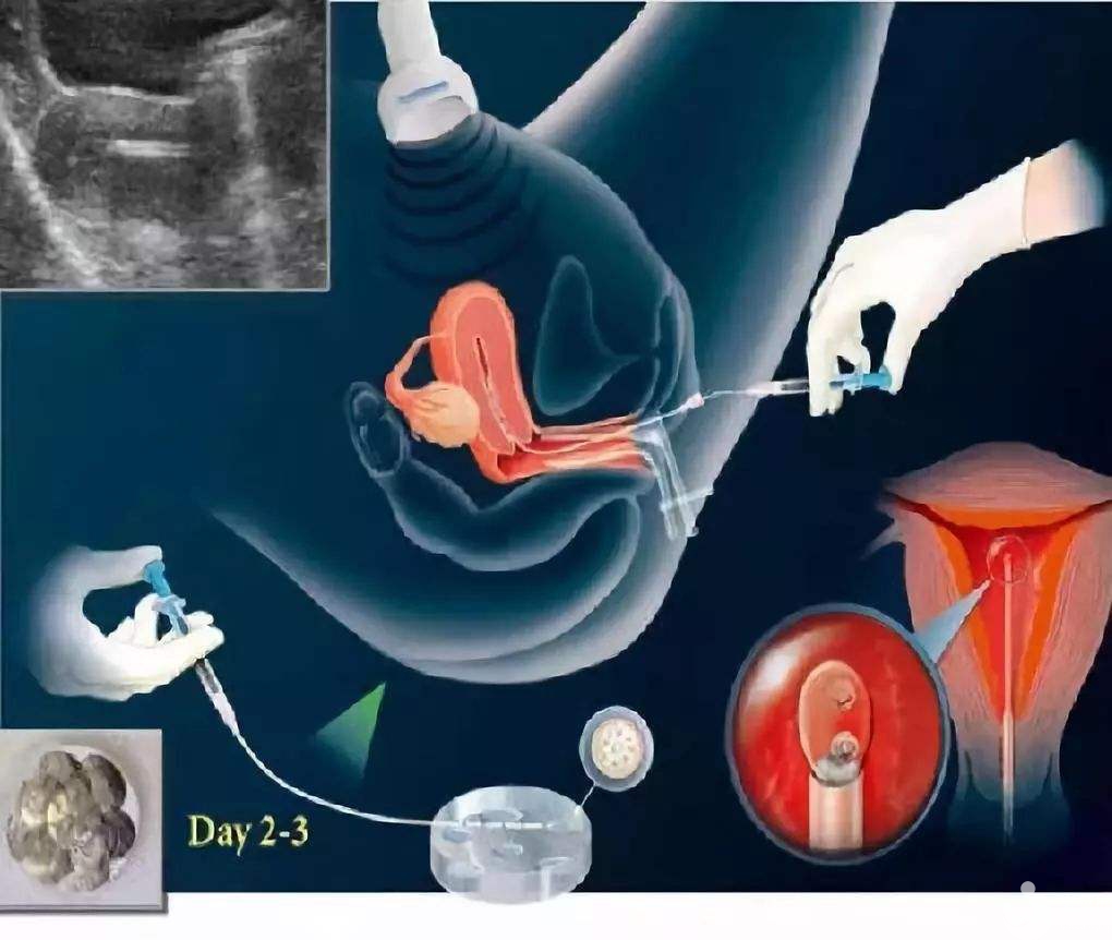 試管嬰兒移植后出血正常嗎？
