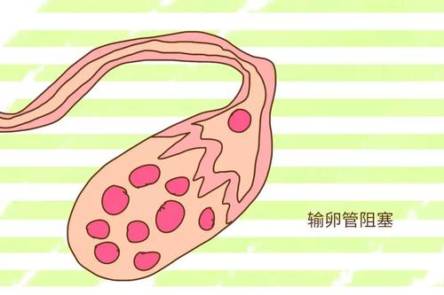 你可能還不夠了解輸卵管為什么會(huì)堵塞！