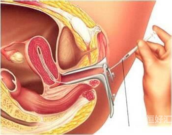 人工授精技術(shù)，你真的了解嗎？