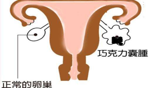 巧克力囊腫，是怎么回事呢？