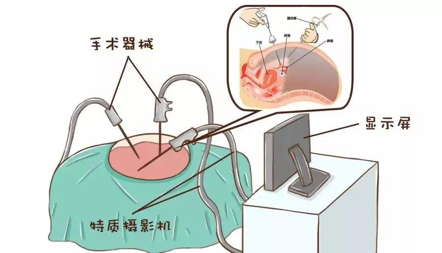 什么人適合腹腔鏡檢查呢？