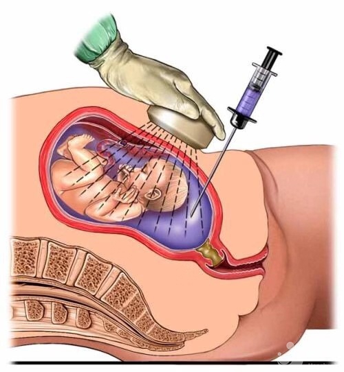 孕婦做羊水檢查，需要注意什么嗎？