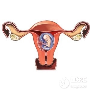 子宮腺肌疾病，可以做試管嬰兒嗎？