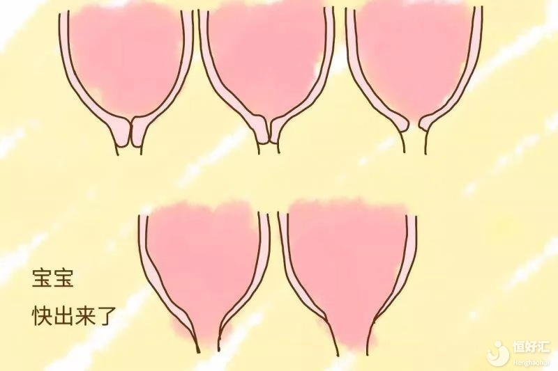 宮頸成熟度有何作用？專家告訴你