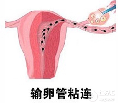 怎么辦？輸卵管又粘連了