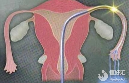 輸卵管通水之后，需要多久才能懷孕？