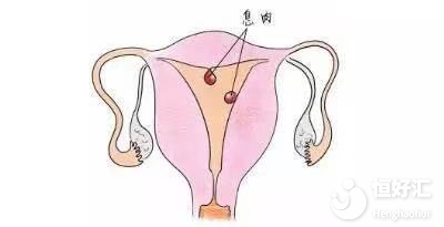 子宮內(nèi)膜息肉是什么樣的疾病，會(huì)影響生育嗎？