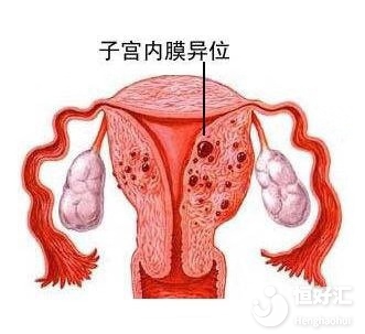 患有子宮內(nèi)膜異位癥，會(huì)影響生育嗎？