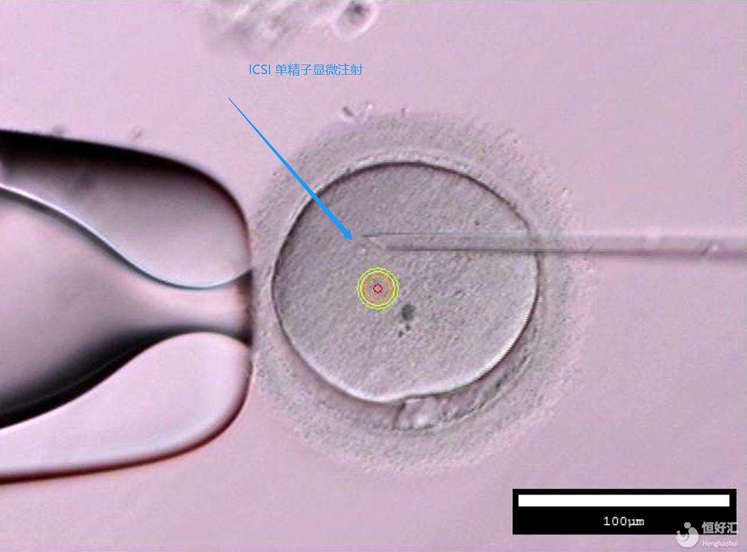 單精子卵泡漿細(xì)胞顯微注射技術(shù)是如何進(jìn)行的呢？
