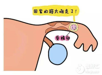 造成現(xiàn)代女性宮外孕的原因有哪些？要怎么預(yù)防？