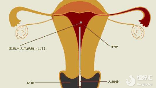 人工授精疼嗎？過(guò)來(lái)人說(shuō)的這番話(huà)很震驚！