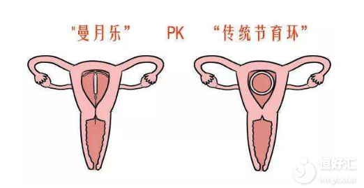 關(guān)于曼月樂(lè)環(huán)如何治病的知識(shí)，看這一篇就夠了！