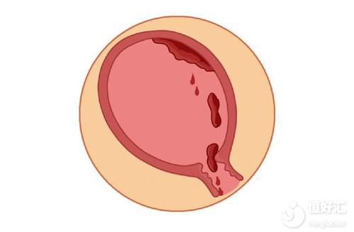 產(chǎn)后子宮恢復(fù)不好？這4大原因脫不了關(guān)系