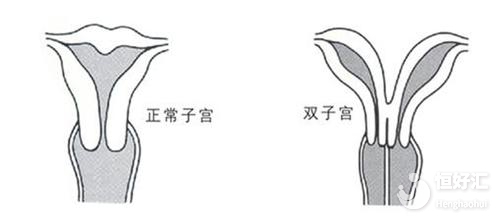 雙角子宮有哪些危害？這幾點(diǎn)請(qǐng)引起重視！