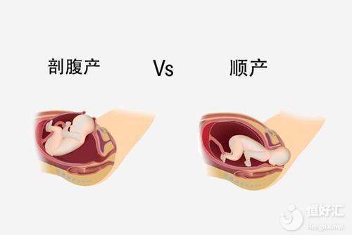順產(chǎn)VS剖腹產(chǎn)最后誰贏了？醫(yī)生：適合的才最好