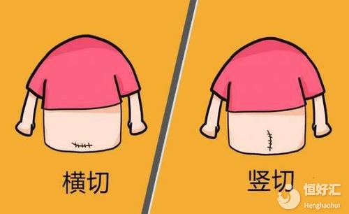 剖腹產(chǎn)橫切PK豎切：到底選擇哪個更好？