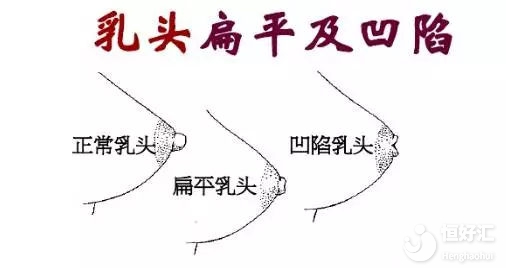 乳頭內(nèi)陷如何喂奶？這些方法希望能幫到你